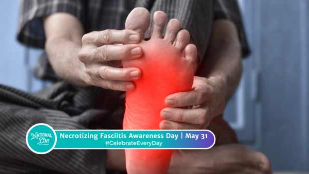 NECROTIZING FASCIITIS AWARENESS DAY  May 31